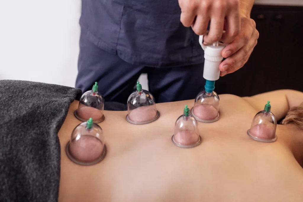 Cupping therapy cups creating suction on the skin