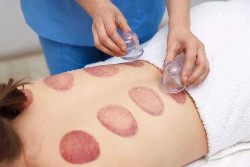 Therapist giving cupping treatment