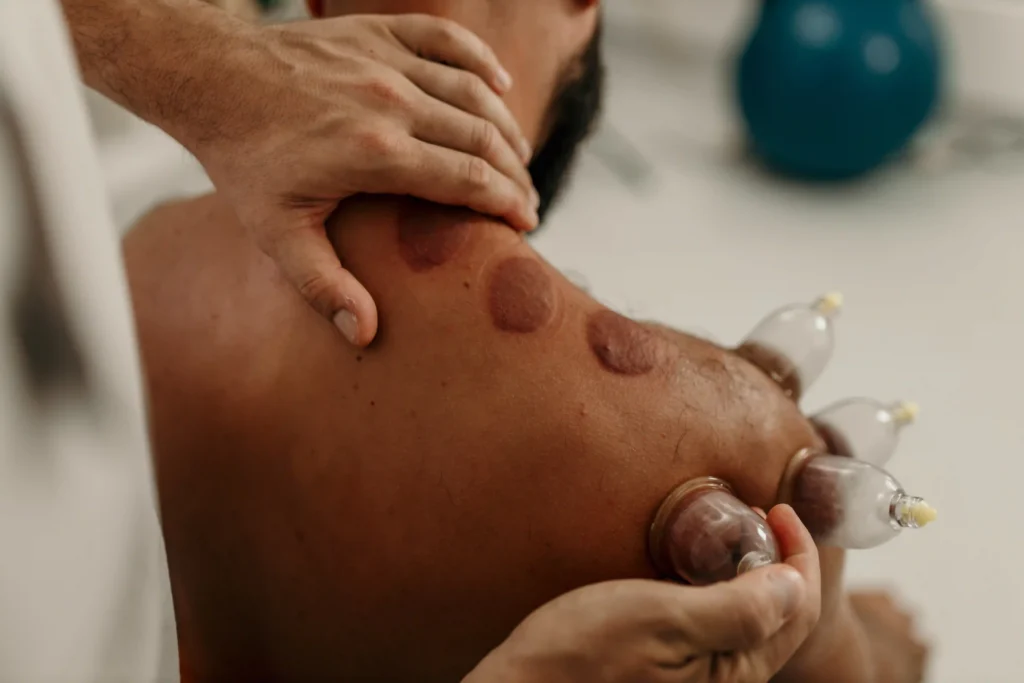 Man Receiving Cupping Therapy for Muscle Tightness