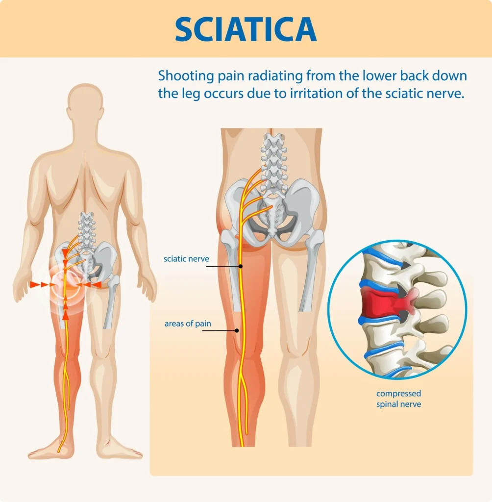 Illustration of sciatica pain and nerve compression